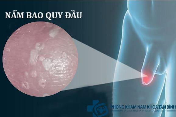 Phòng khám nấm bao quy đầu uy tín quận Tân Bình