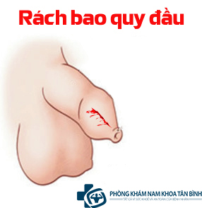  Phòng khám rách bao quy đầu uy tín quận Tân Bình