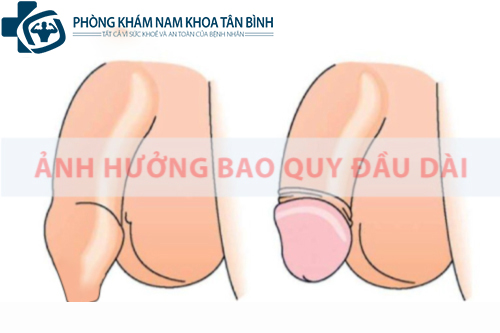  Bao quy đầu dài có ảnh hưởng gì không?