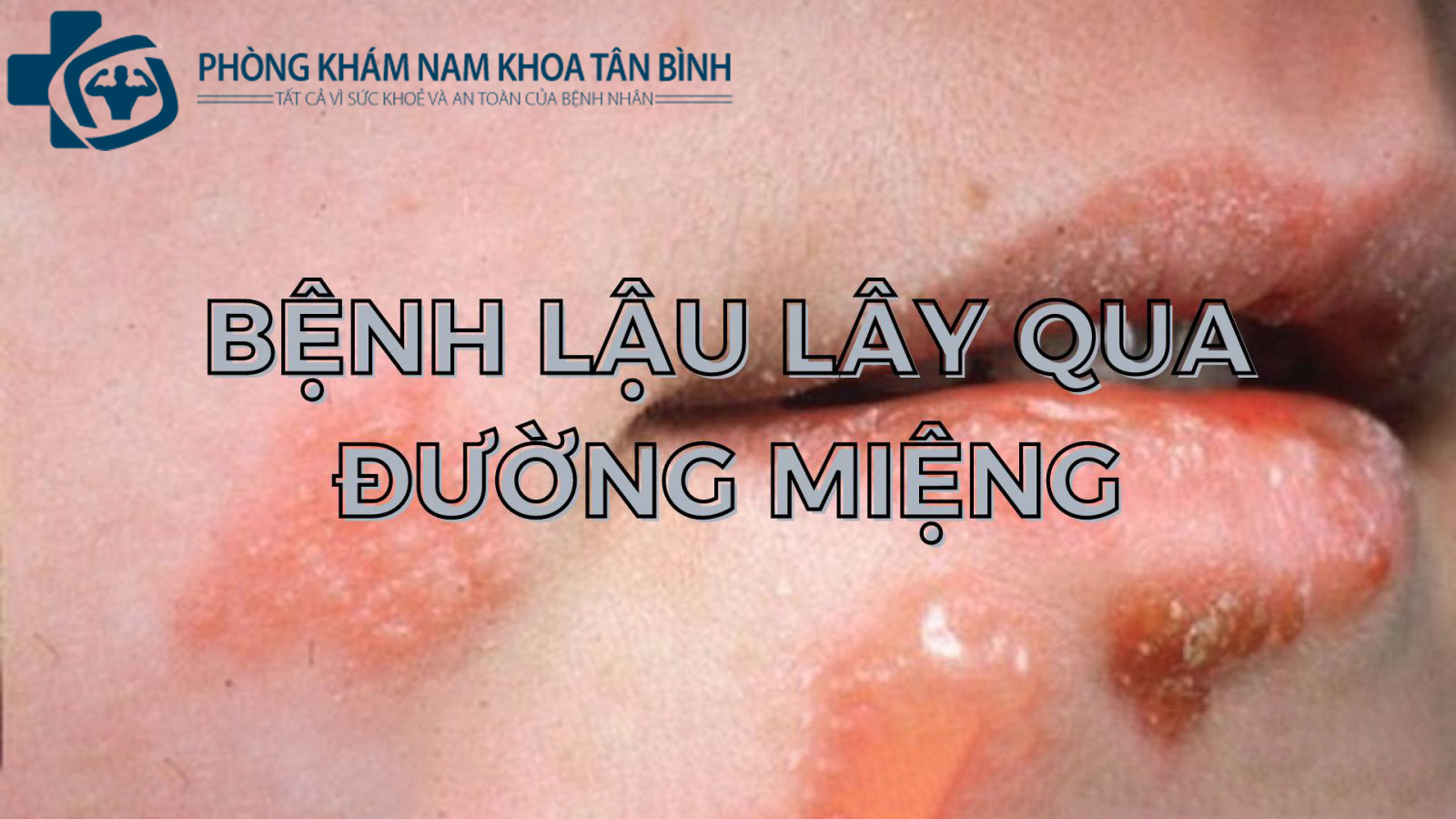 Bật mí bí mật: Bệnh lậu có lây qua đường miệng không?