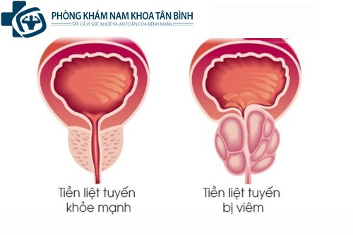  Cách chữa trị viêm tuyến tiền liệt ở nam giới hiệu quả