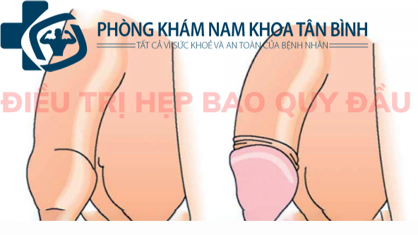  Cách điều trị hẹp bao quy đầu ở nam giới