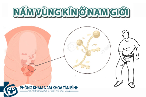 Cách điều trị nấm vùng kín ở nam giới