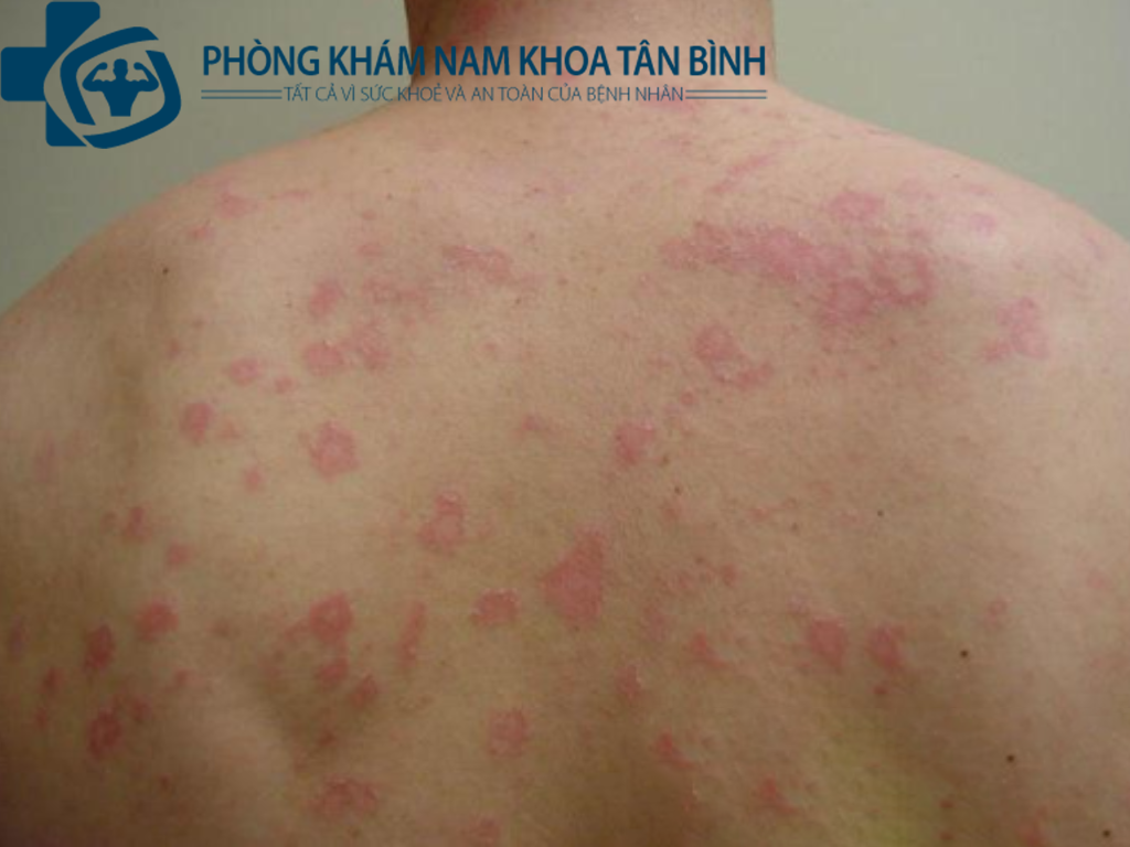 chữa trị bệnh giang mai ở nam giới bao nhiêu tiền