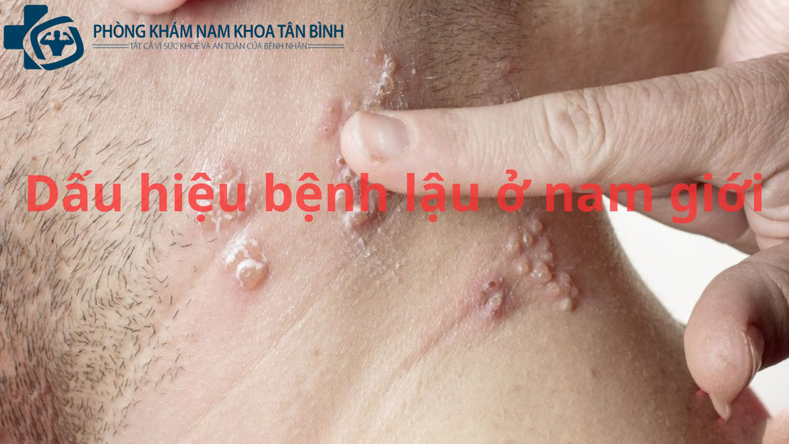 Chữa trị bệnh lậu ở nam giới bao nhiêu tiền