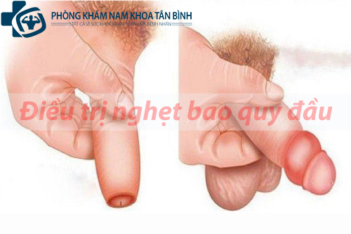  Nghẹt bao quy đầu có nguy hiểm không?