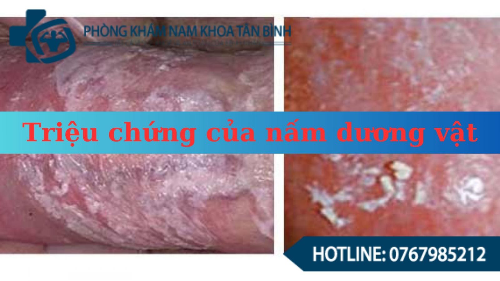 Nguyên nhân gây bệnh nấm dương vật ở nam giới