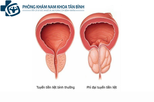  Những bệnh tuyến tiền liệt thường gặp ở nam giới