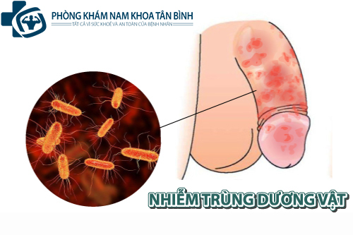  Những dấu hiệu nhận biết nhiễm trùng dương vật