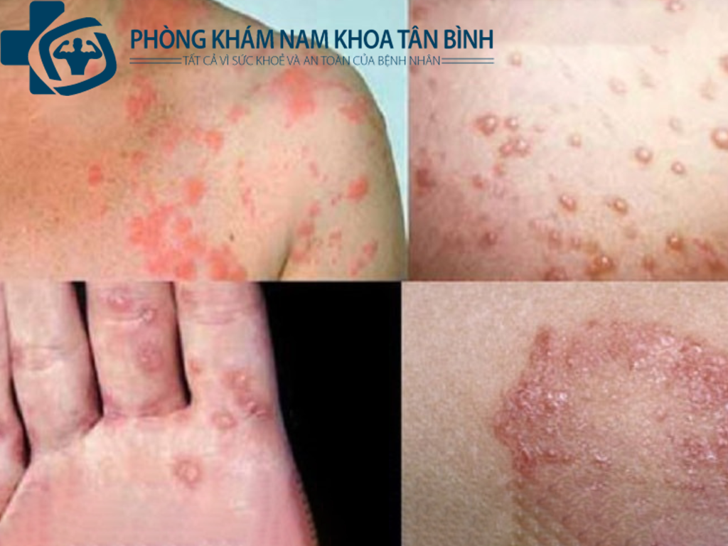 phòng khám bệnh giang mai uy tín quận tân bình