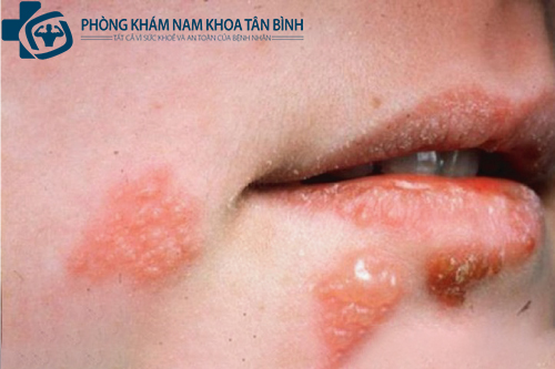 Phòng khám chữa bệnh lậu uy tín quận Tân Bình